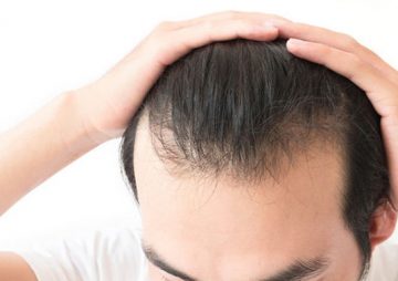 [ Giải-Đáp ]: Bị hói đầu khi còn trẻ phải làm sao?