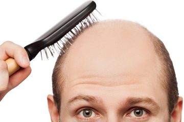 Nguyên nhân và cách chữa hói đầu ở nam giới hiệu quả