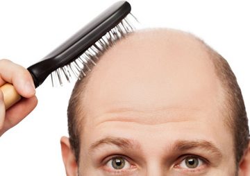 Nguyên nhân và cách chữa hói đầu ở nam giới hiệu quả