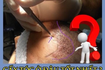 Cấy tóc ở đâu tốt nhất? Top 3 địa chỉ cấy tóc bạn nên biết