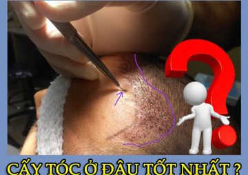 Cấy tóc ở đâu tốt nhất? Top 3 địa chỉ cấy tóc bạn nên biết