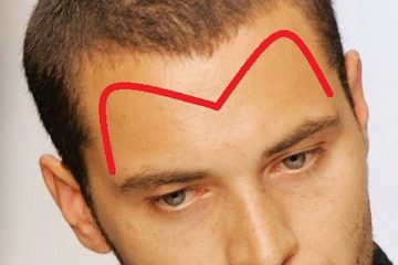 [Bất Ngờ] Cách chữa hói chữ M hiệu quả cho cánh mày râu