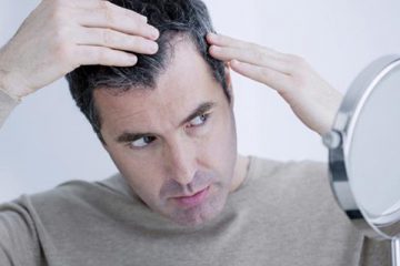 Hói Trán – Nguyên nhân và cách điều trị hiệu quả nhất