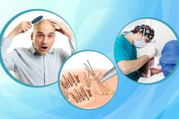 Chi phí cấy tóc tự thân có đắt không? Những điều cần lưu ý