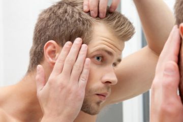 Giải đáp: Chữa hói 2 bên trán có được không?