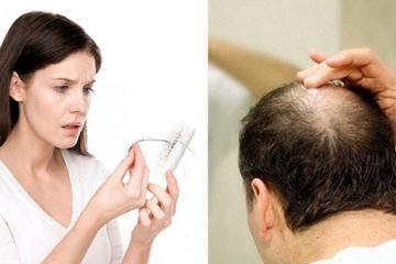 [ Tìm Hiểu ] : Rụng tóc, hói đầu phải làm sao để trị dứt điểm?