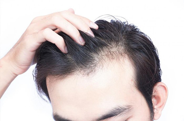 Rụng tóc ở nam tuổi 20 có đáng lo ngại Làm sao để khắc phục