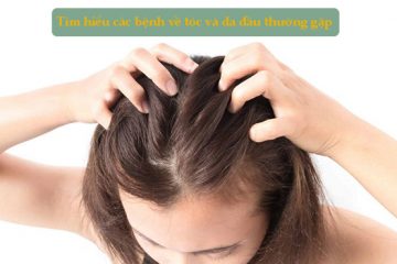 Tìm hiểu cách khắc phục các bệnh về tóc và da đầu thường gặp