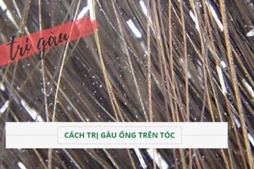 TOP 5 cách trị gàu ống đơn giản tại nhà thông dụng nhất hiện nay