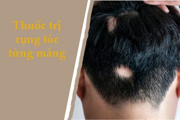 Đánh giá 3 loại thuốc trị rụng tóc từng mảng được chuyên gia khuyên dùng