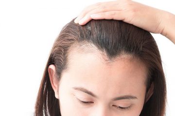 [Có thể bạn muốn biết] Con gái hói trước trán phải làm sao?