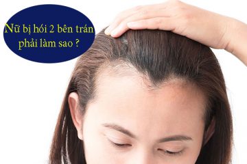 [ Tìm Hiểu ]: Nữ bị hói 2 bên trán xử lý như thế nào?