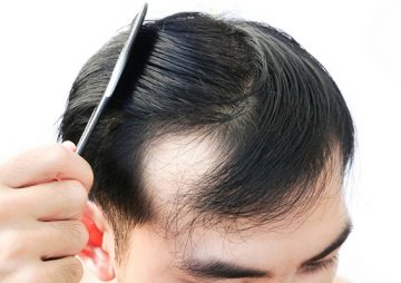 Bị hói đầu khi còn trẻ làm thế nào để phủ xanh mái tóc?