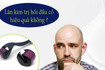 [ Tìm Hiểu ] : Lăn kim trị hói đầu liệu có thực sự hiệu quả?