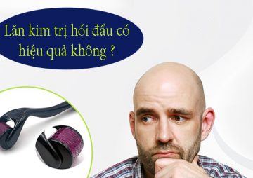 [ Tìm Hiểu ] : Lăn kim trị hói đầu liệu có thực sự hiệu quả?