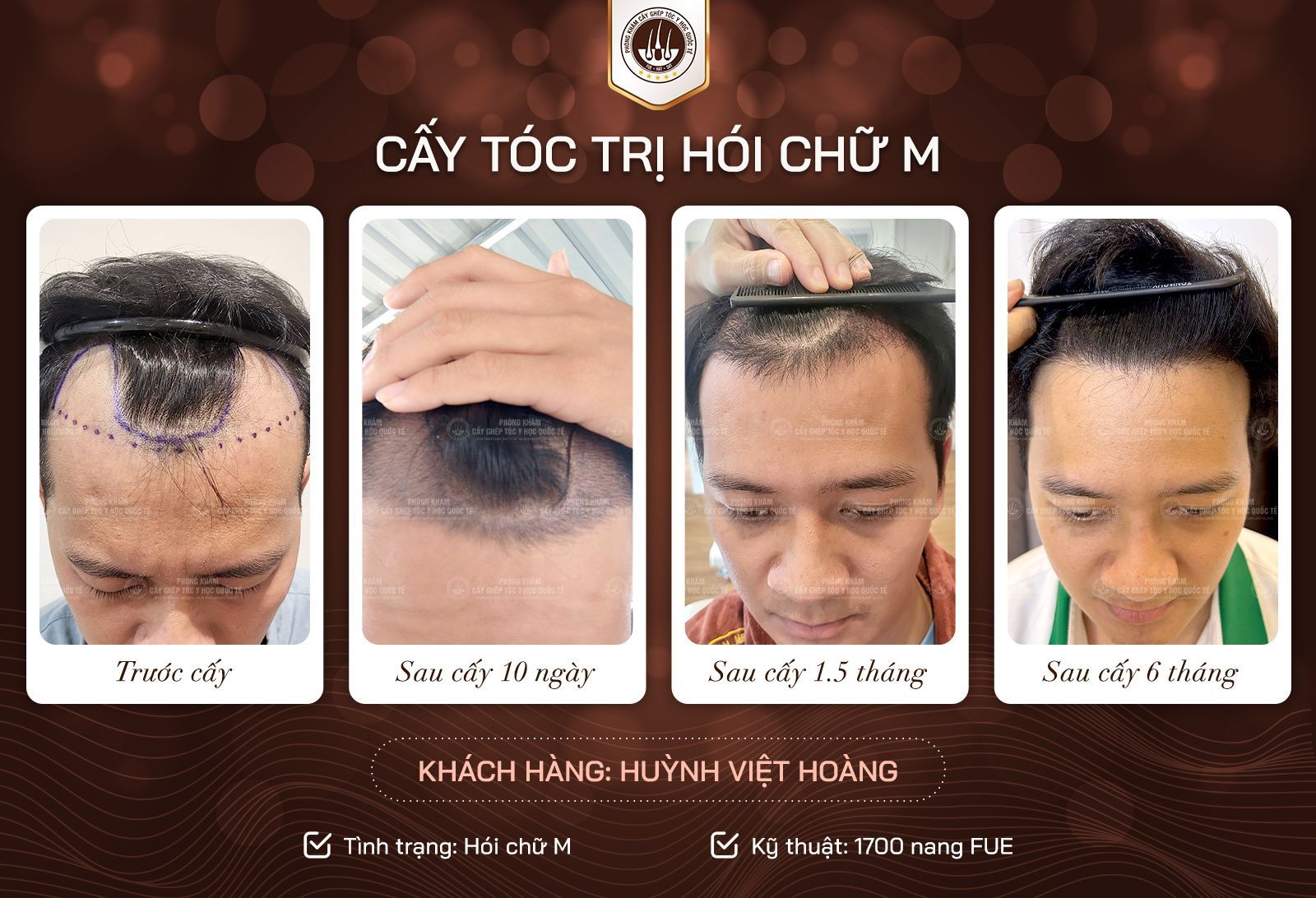 Trung tâm Cấy tóc Y học Hải Phòng ở đâu? Thông tin địa chỉ và dịch vụ chi tiết Trung tâm Cấy tóc Y học Hải Phòng ở đâu? Thông tin địa chỉ và dịch vụ chi tiết