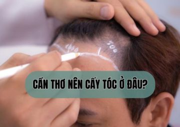 Cần Thơ nên cấy tóc ở đâu? Top 6 địa chỉ cấy tóc uy tín – An toàn