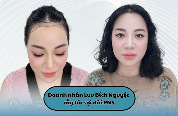 Phỏng vấn doanh nhân Lưu Bích Nguyệt cấy tóc sợi dài PNS và hiệu quả thực tế