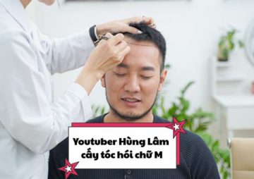 Youtuber Hùng Lâm cấy tóc hói chữ M: Chia sẻ thẳng thắn của người trong cuộc