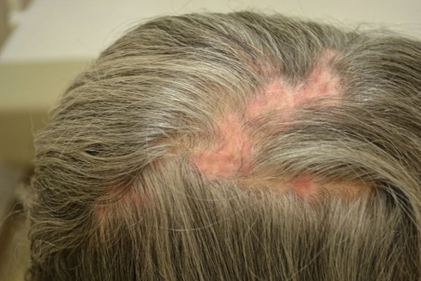 Bệnh Lupus ban đỏ gây rụng tóc