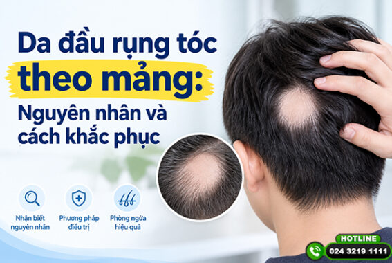 Da đầu rụng tóc theo mảng: Nguyên nhân và cách khắc phục