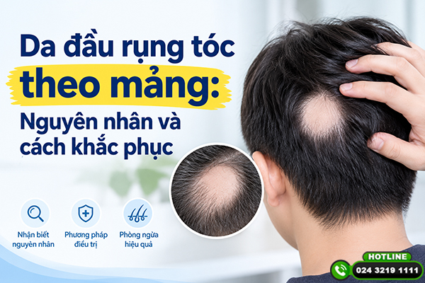 Da đầu rụng tóc theo mảng