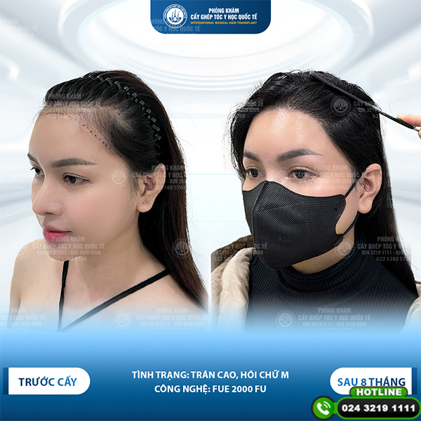 cấy tóc tự thân
