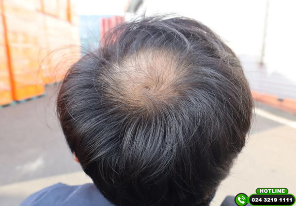 dấu hiệu hói đầu