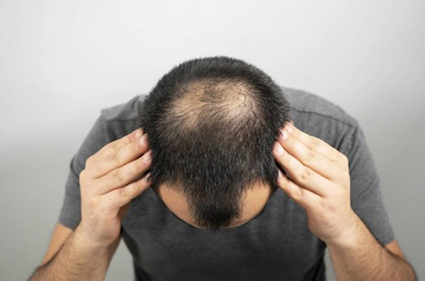 Nguyên nhân gây hói đầu