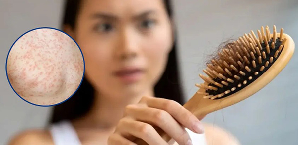 Sốt xuất huyết có gây rụng tóc không