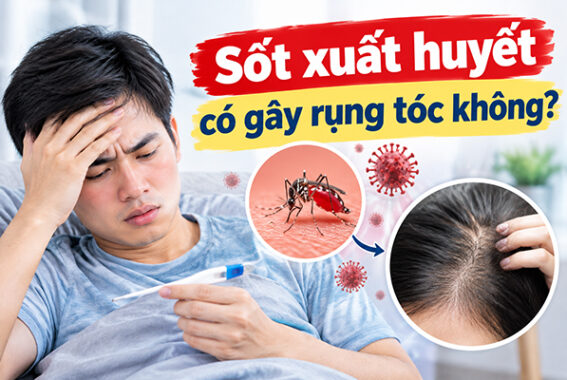 Sốt xuất huyết có gây rụng tóc không? Chia sẻ chuyên gia