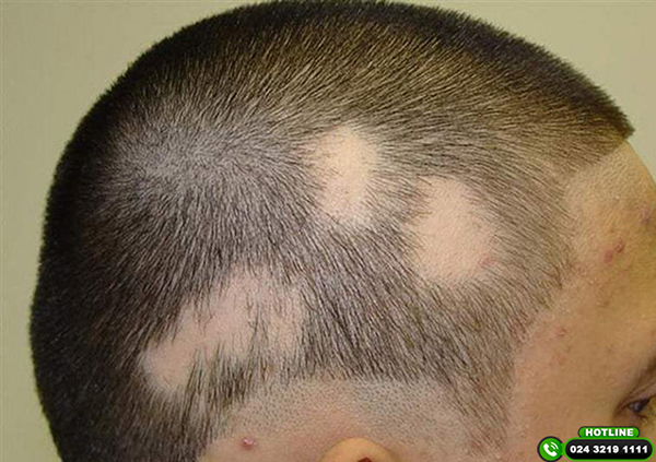 rụng tóc từng mảng