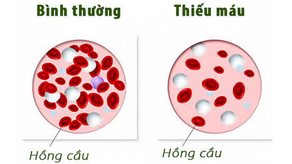 Bệnh thiếu máu gây rụng tóc