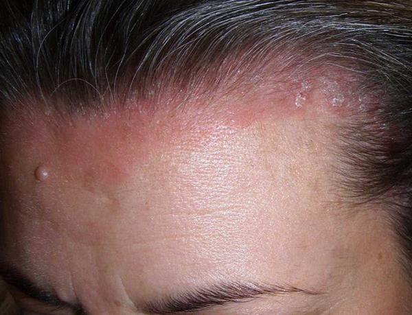 Nguyên nhân tóc gãy rụng ở nam giới
