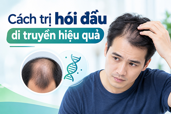 cách trị hói đầu di truyền hiệu quả