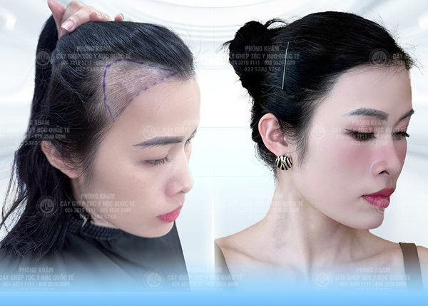 cấy tóc tự thân