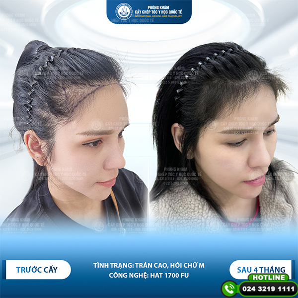 cấy tóc tự thân
