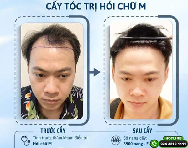 cấy tóc tự thân