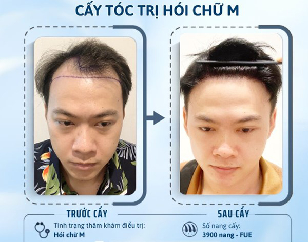 cấy tóc tự thân