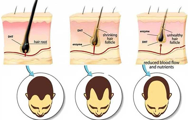 Nguyên nhân tóc gãy rụng ở nam giới