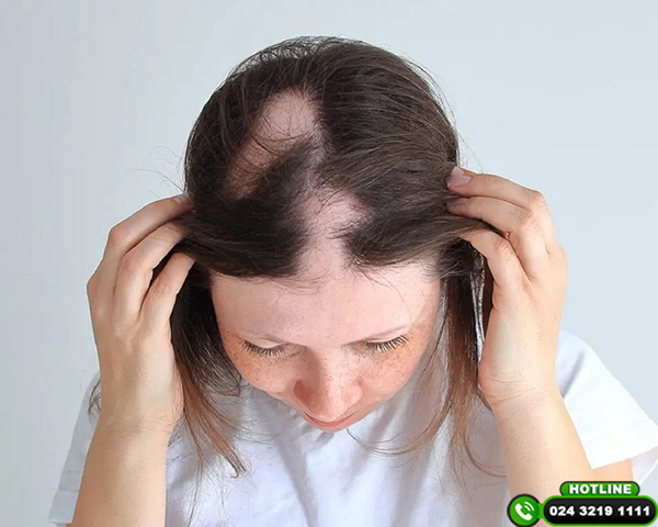 rụng tóc từng mảng