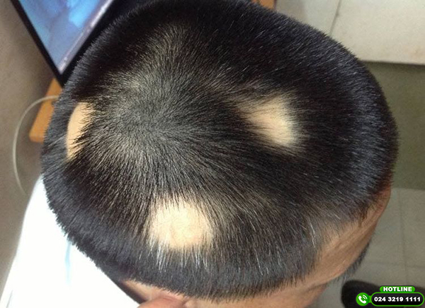 rụng tóc từng mảng