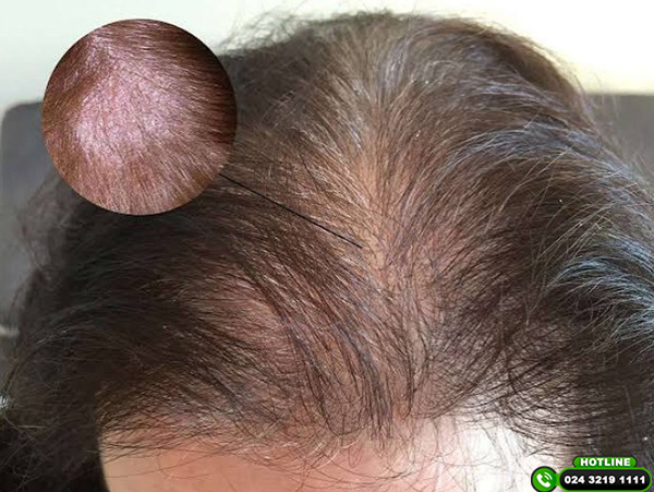 Rụng tóc do tăng tiết bã nhờn: Nguyên nhân và cách khắc phục