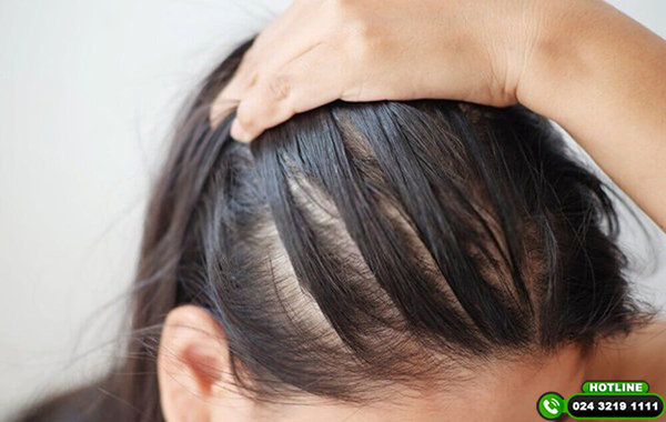 Rụng tóc do tăng tiết bã nhờn: Nguyên nhân và cách khắc phục